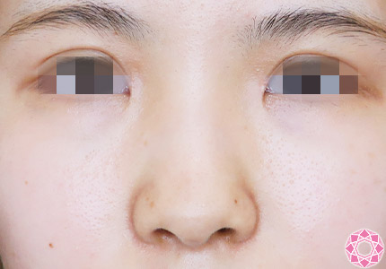 年代：20代 施術名：プチ隆鼻術（ヒアルロン酸） 施術前｜【公式】東京形成美容外科