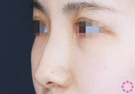 年代：20代 施術名：プチ隆鼻術（ヒアルロン酸） 施術前｜【公式】東京形成美容外科