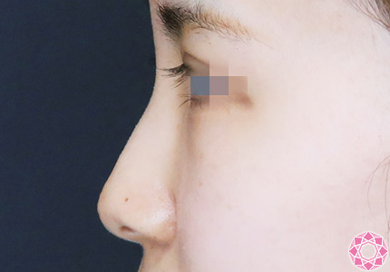 年代：20代 施術名：プチ隆鼻術（ヒアルロン酸） 施術前｜【公式】東京形成美容外科