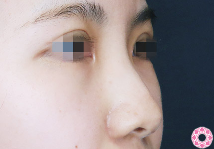 年代：20代 施術名：プチ隆鼻術（ヒアルロン酸） 施術前｜【公式】東京形成美容外科