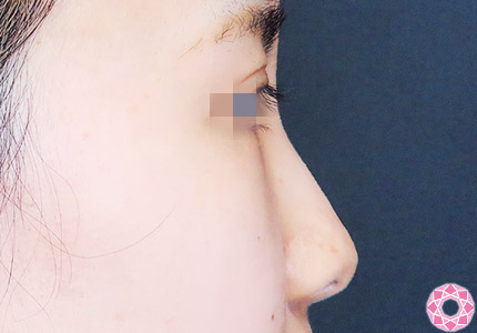 年代：20代 施術名：プチ隆鼻術（ヒアルロン酸） 施術前｜【公式】東京形成美容外科