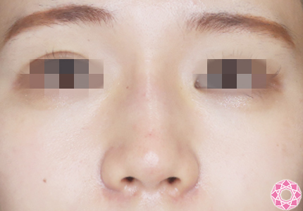 年代：20代 施術名：プチ隆鼻術（ヒアルロン酸） 施術後｜【公式】東京形成美容外科