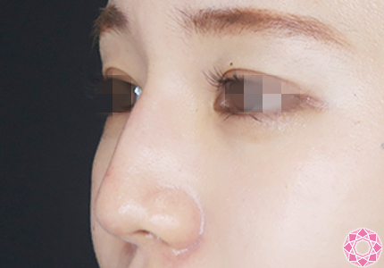 年代：20代 施術名：プチ隆鼻術（ヒアルロン酸） 施術後｜【公式】東京形成美容外科