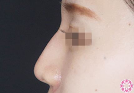 年代：20代 施術名：プチ隆鼻術（ヒアルロン酸） 施術後｜【公式】東京形成美容外科