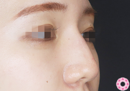 年代：20代 施術名：プチ隆鼻術（ヒアルロン酸） 施術後｜【公式】東京形成美容外科