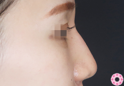 年代：20代 施術名：プチ隆鼻術（ヒアルロン酸） 施術後｜【公式】東京形成美容外科