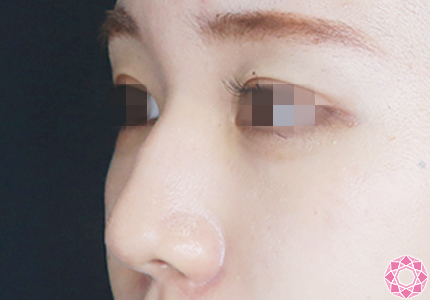 年代：20代 施術名：プチ隆鼻術（ヒアルロン酸） 施術前｜【公式】東京形成美容外科