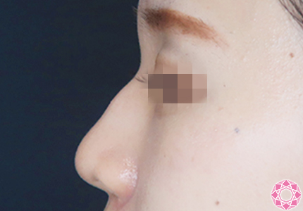 年代：20代 施術名：プチ隆鼻術（ヒアルロン酸） 施術前｜【公式】東京形成美容外科