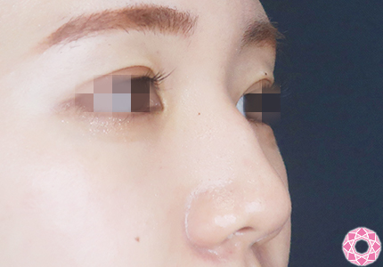 年代：20代 施術名：プチ隆鼻術（ヒアルロン酸） 施術前｜【公式】東京形成美容外科