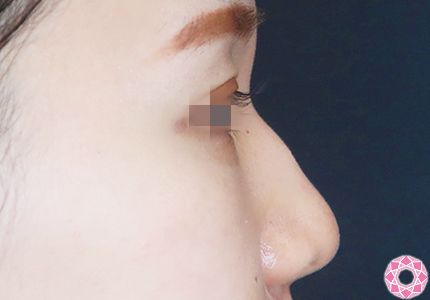 年代：20代 施術名：プチ隆鼻術（ヒアルロン酸） 施術前｜【公式】東京形成美容外科