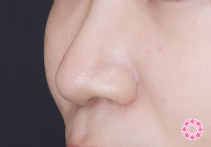 年代：20代 施術名：小鼻縮小 施術後｜【公式】東京形成美容外科
