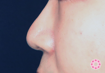 年代：20代 施術名：小鼻縮小 施術後｜【公式】東京形成美容外科