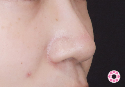 年代：20代 施術名：小鼻縮小 施術後｜【公式】東京形成美容外科