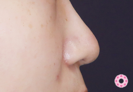 年代：20代 施術名：小鼻縮小 施術後｜【公式】東京形成美容外科