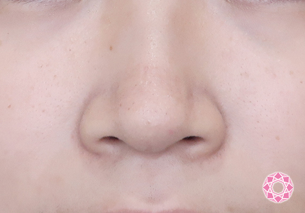 年代：20代 施術名：小鼻縮小 施術前｜【公式】東京形成美容外科
