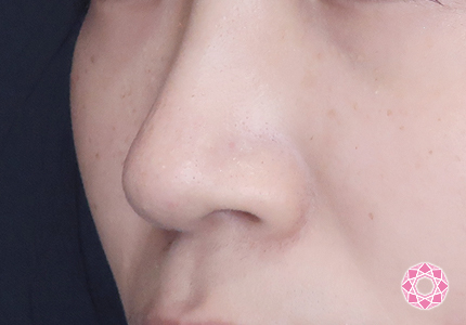 年代：20代 施術名：小鼻縮小 施術前｜【公式】東京形成美容外科