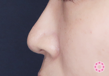 年代：20代 施術名：小鼻縮小 施術前｜【公式】東京形成美容外科