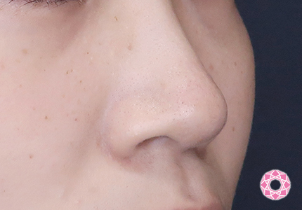 年代：20代 施術名：小鼻縮小 施術前｜【公式】東京形成美容外科