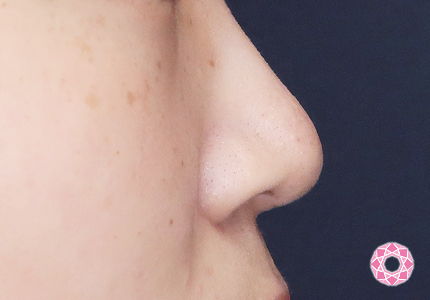 年代：20代 施術名：小鼻縮小 施術前｜【公式】東京形成美容外科