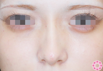 年代：20代 施術名：プチ隆鼻術（ヒアルロン酸） 施術後｜【公式】東京形成美容外科