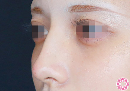 年代：20代 施術名：プチ隆鼻術（ヒアルロン酸） 施術後｜【公式】東京形成美容外科