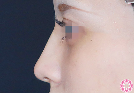 年代：20代 施術名：プチ隆鼻術（ヒアルロン酸） 施術後｜【公式】東京形成美容外科