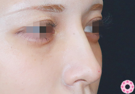 年代：20代 施術名：プチ隆鼻術（ヒアルロン酸） 施術後｜【公式】東京形成美容外科