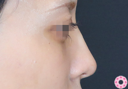 年代：20代 施術名：プチ隆鼻術（ヒアルロン酸） 施術後｜【公式】東京形成美容外科