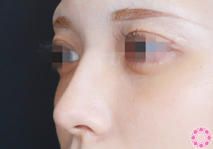 年代：20代 施術名：プチ隆鼻術（ヒアルロン酸） 施術前｜【公式】東京形成美容外科