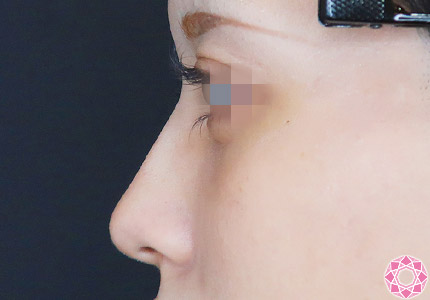 年代：20代 施術名：プチ隆鼻術（ヒアルロン酸） 施術前｜【公式】東京形成美容外科