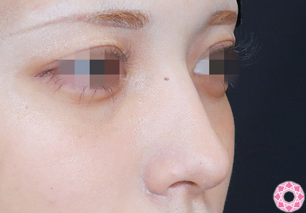 年代：20代 施術名：プチ隆鼻術（ヒアルロン酸） 施術前｜【公式】東京形成美容外科