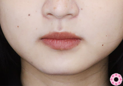 年代：20代 施術名：アゴのヒアルロン酸注入 施術後｜【公式】東京形成美容外科