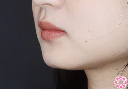 年代：20代 施術名：アゴのヒアルロン酸注入 施術後｜【公式】東京形成美容外科