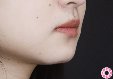 年代：20代 施術名：アゴのヒアルロン酸注入 施術後｜【公式】東京形成美容外科