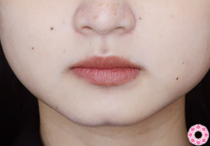 年代：20代 施術名：アゴのヒアルロン酸注入 施術前｜【公式】東京形成美容外科