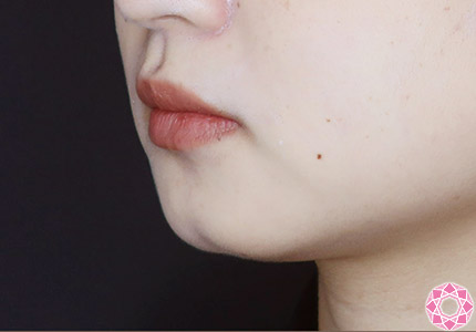 年代：20代 施術名：アゴのヒアルロン酸注入 施術前｜【公式】東京形成美容外科