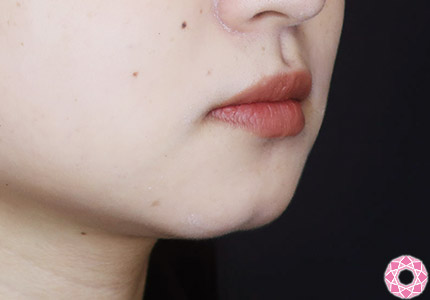 年代：20代 施術名：アゴのヒアルロン酸注入 施術前｜【公式】東京形成美容外科