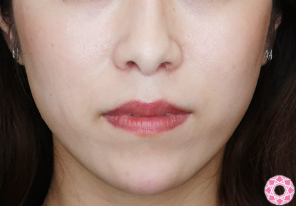 年代：30代 施術名：アゴのヒアルロン酸注入 施術後｜【公式】東京形成美容外科