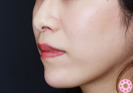 年代：30代 施術名：アゴのヒアルロン酸注入 施術後｜【公式】東京形成美容外科