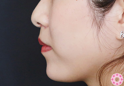 年代：30代 施術名：アゴのヒアルロン酸注入 施術後｜【公式】東京形成美容外科