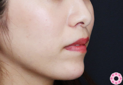 年代：30代 施術名：アゴのヒアルロン酸注入 施術後｜【公式】東京形成美容外科