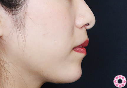 年代：30代 施術名：アゴのヒアルロン酸注入 施術後｜【公式】東京形成美容外科