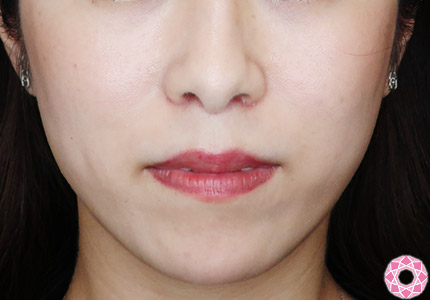 年代：30代 施術名：アゴのヒアルロン酸注入 施術前｜【公式】東京形成美容外科