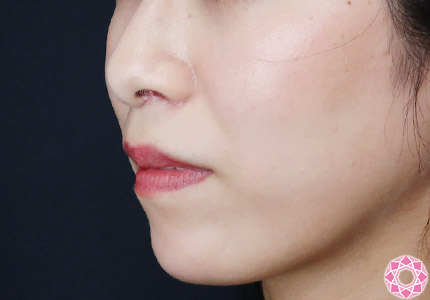 年代：30代 施術名：アゴのヒアルロン酸注入 施術前｜【公式】東京形成美容外科
