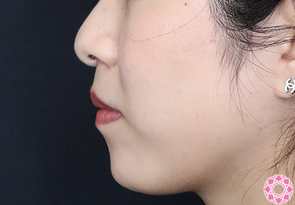 年代：30代 施術名：アゴのヒアルロン酸注入 施術前｜【公式】東京形成美容外科
