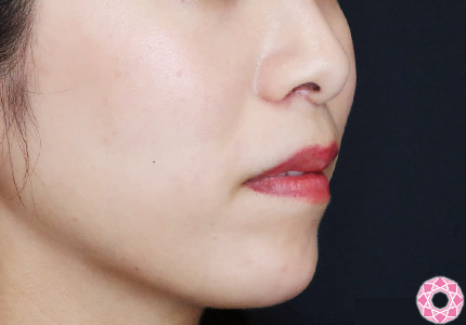 年代：30代 施術名：アゴのヒアルロン酸注入 施術前｜【公式】東京形成美容外科