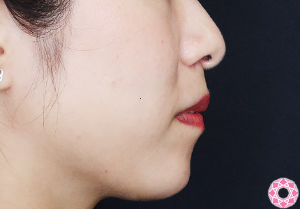 年代：30代 施術名：アゴのヒアルロン酸注入 施術前｜【公式】東京形成美容外科
