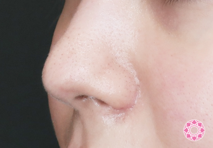 年代：20代 施術名：小鼻縮小 施術後｜【公式】東京形成美容外科