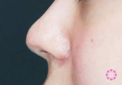 年代：20代 施術名：小鼻縮小 施術後｜【公式】東京形成美容外科