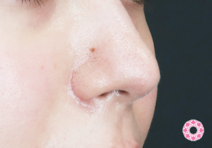 年代：20代 施術名：小鼻縮小 施術後｜【公式】東京形成美容外科